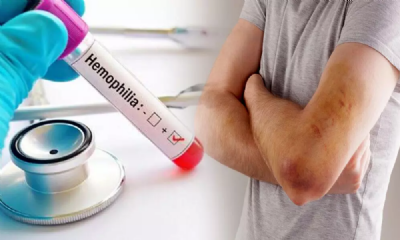hemophilia disease