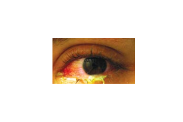 EyeHealth
