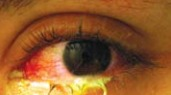ink-eye-symptoms